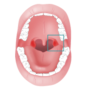 Sore tonsils