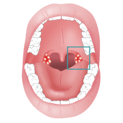 Spots tonsils